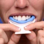 Apnea Oral Appliance